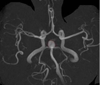 頭部MRA→脳動脈瘤